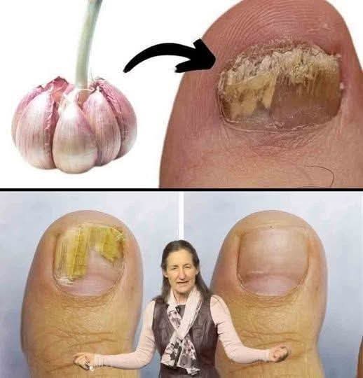 El ajo: un remedio natural y efectivo contra los hongos en los pies