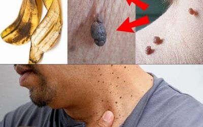 Eliminar verrugas fibromas, espinillas y manchas