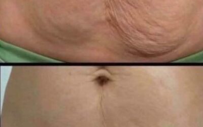 Cómo tratar la piel flácida de forma natural
