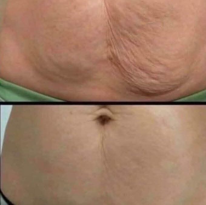 Cómo tratar la piel flácida de forma natural