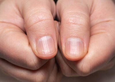 Líneas en las Uñas: Descifrando el Mensaje que Envía tu Cuerpo