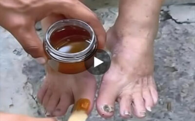 hongos”: un remedio natural para pies y uñas