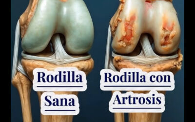 RODILLAS SANAS: