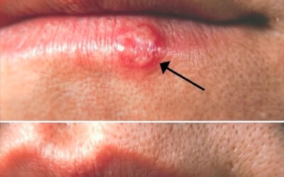 Señales en la boca: lo que tu cuerpo podría estar intentando decirte