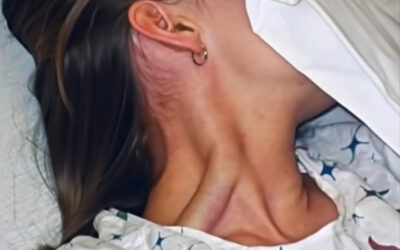 Contracturas en el cuello