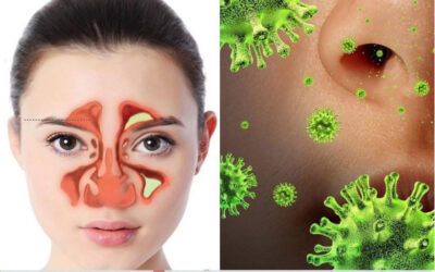 Elimina el moco, la flema en la garganta y nariz, rinitis