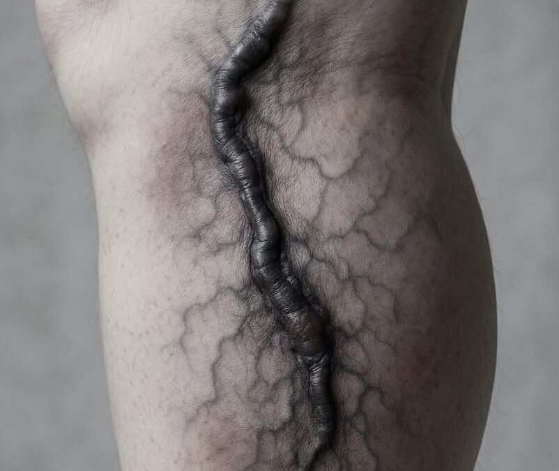 El enemigo silencioso que puede viajar desde tu pierna hasta tus pulmones