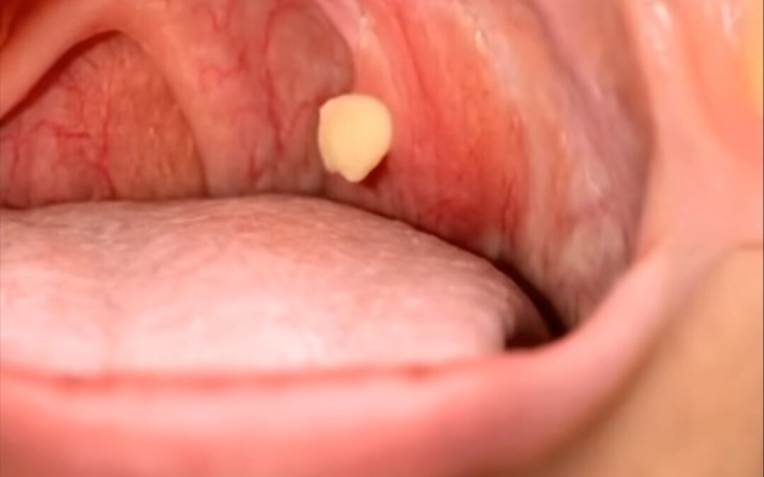Todo lo que debes saber sobre las bolitas blancas en tu garganta