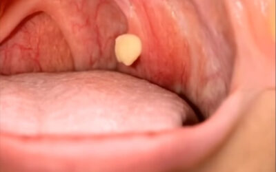 Todo lo que debes saber sobre las bolitas blancas en tu garganta