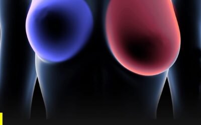 SINTOMAS DEL CANCER DE MAMA QUE NO DEBES IGNORAR