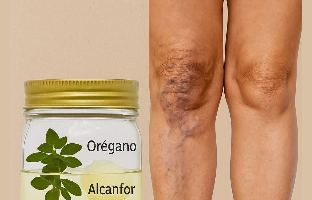 🌿 Remedio natural tradicional para el alivio de las varices