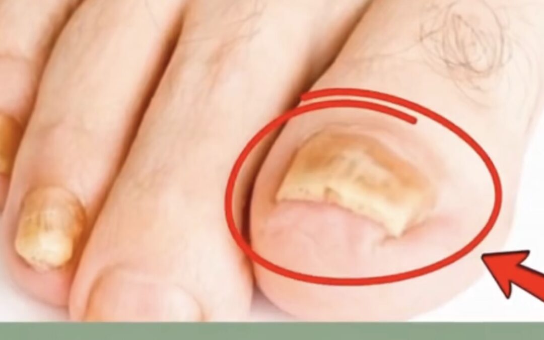 Elimina el Hongo de las Uñas con Clavos de Olor de Manera Natural y Efectiva