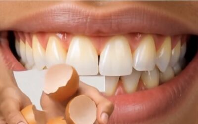 para Eliminar el Sarro y Blanquear los Dientes en Casa