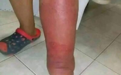 Primeros Síntomas de Inflamación y Remedios Naturales para Aliviarlos