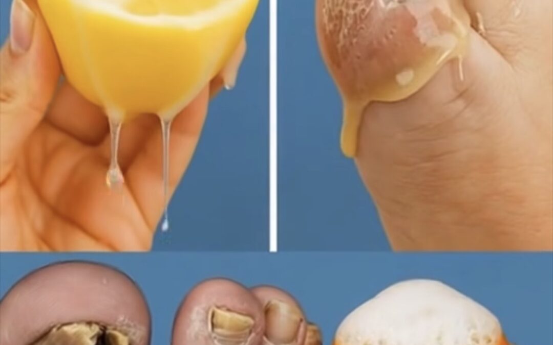 Adiós a los Hongos! El Remedio Casero Antimicótico que Transformará tus Pies y Uñas