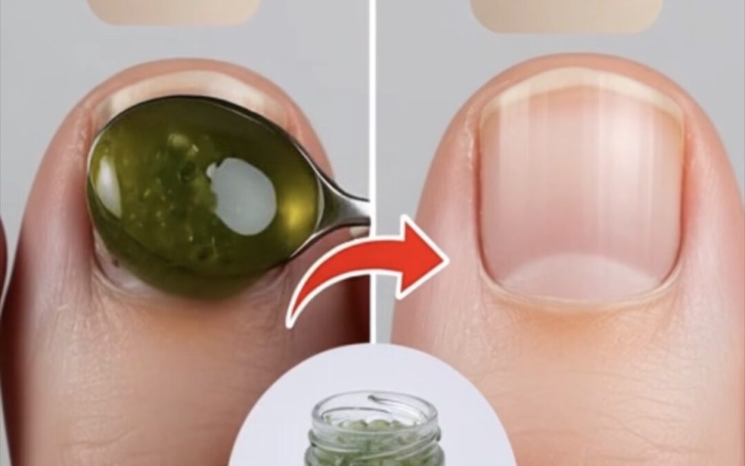 Adiós a los Hongos: