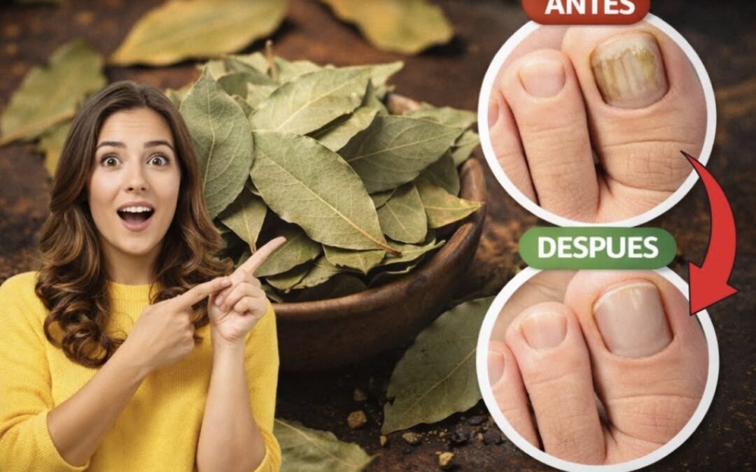 Laurel para hongos en las uñas