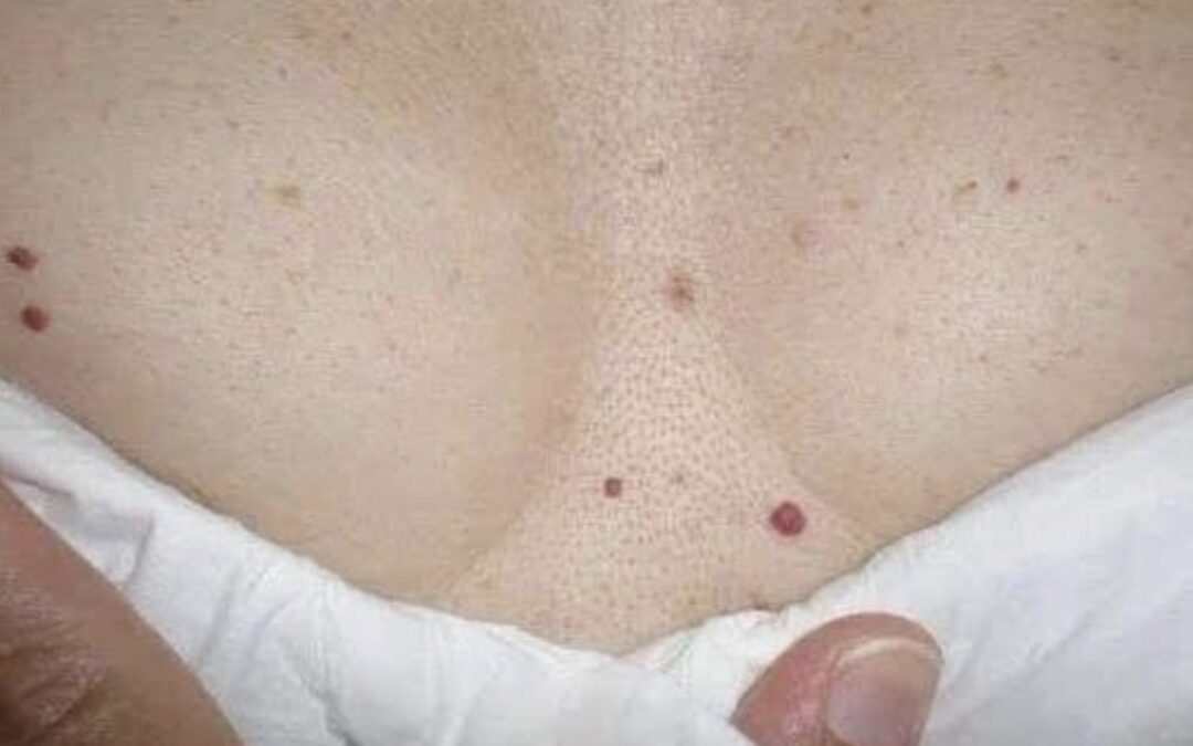 TIENES ESTOS PUNTOS ROJOS EN TU CUERPO? DEBES SABER ESTO